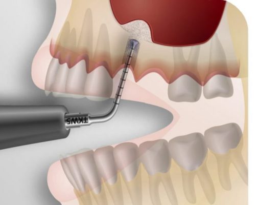 Остеопластические операции в стоматологии